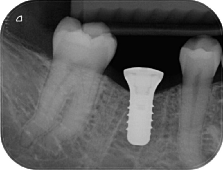 2/Implant en place